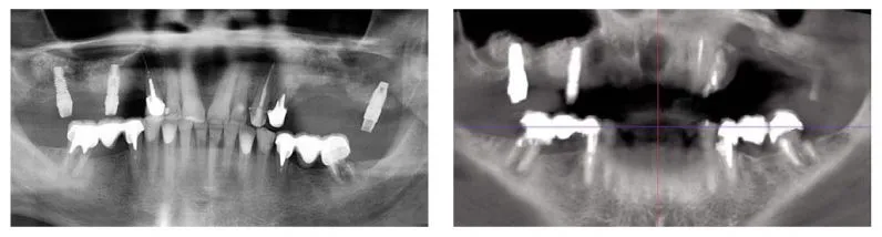 Installation of basal implants with a transinusal method on the upper jaw, as an alternative to sinus lift