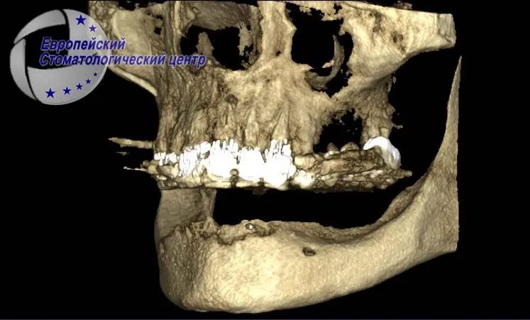 Features of the surgical stage of dental implantation under complex anatomical and topographic conditions of the lower jaw