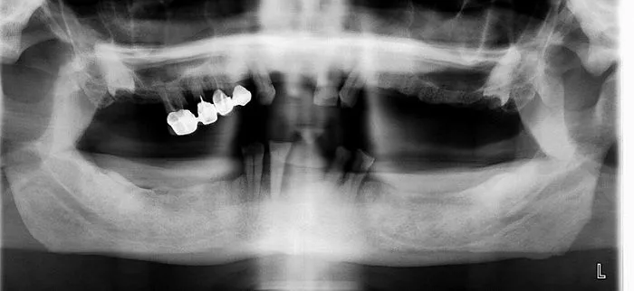 Optimization of the approach to the installation of implants in the tubercle-pterygoid suture