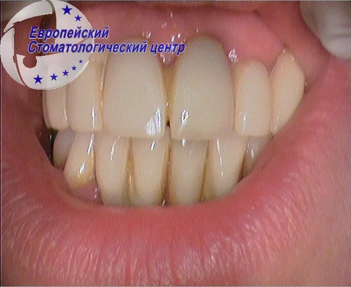 implantacija 3k